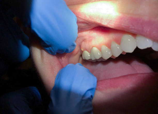 Best Emergency Broken Tooth Repair in Pioneer, CA